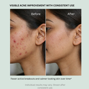 2% Salicylic Acid Soap for Oily, Acne-Prone Skin, Breakouts & Pore Cleansing - Pack of 2