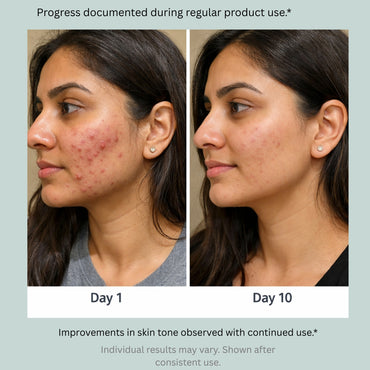 Blushlin 2% Salicylic Acid Face Serum | Anti-Acne, Anti-Clogging & Oil Control