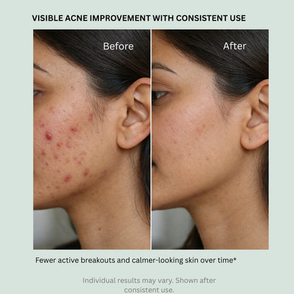 2% Salicylic Acid Soap for Oily, Acne-Prone Skin, Breakouts & Pore Cleansing - Pack of 2