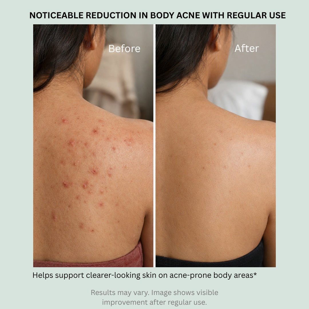2% Salicylic Acid Soap for Oily, Acne-Prone Skin, Breakouts & Pore Cleansing - Pack of 2
