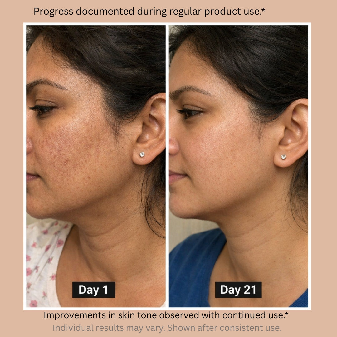10% Tranexamic Acid Cream helps Pigmentation, Even Skin Tone, Reduce Dark Spots, Blemishes and Scars - 10gm |